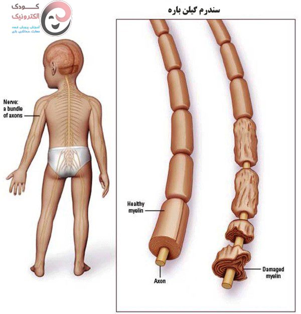 همه چیز در مورد سندرم گیلن باره یا GBS