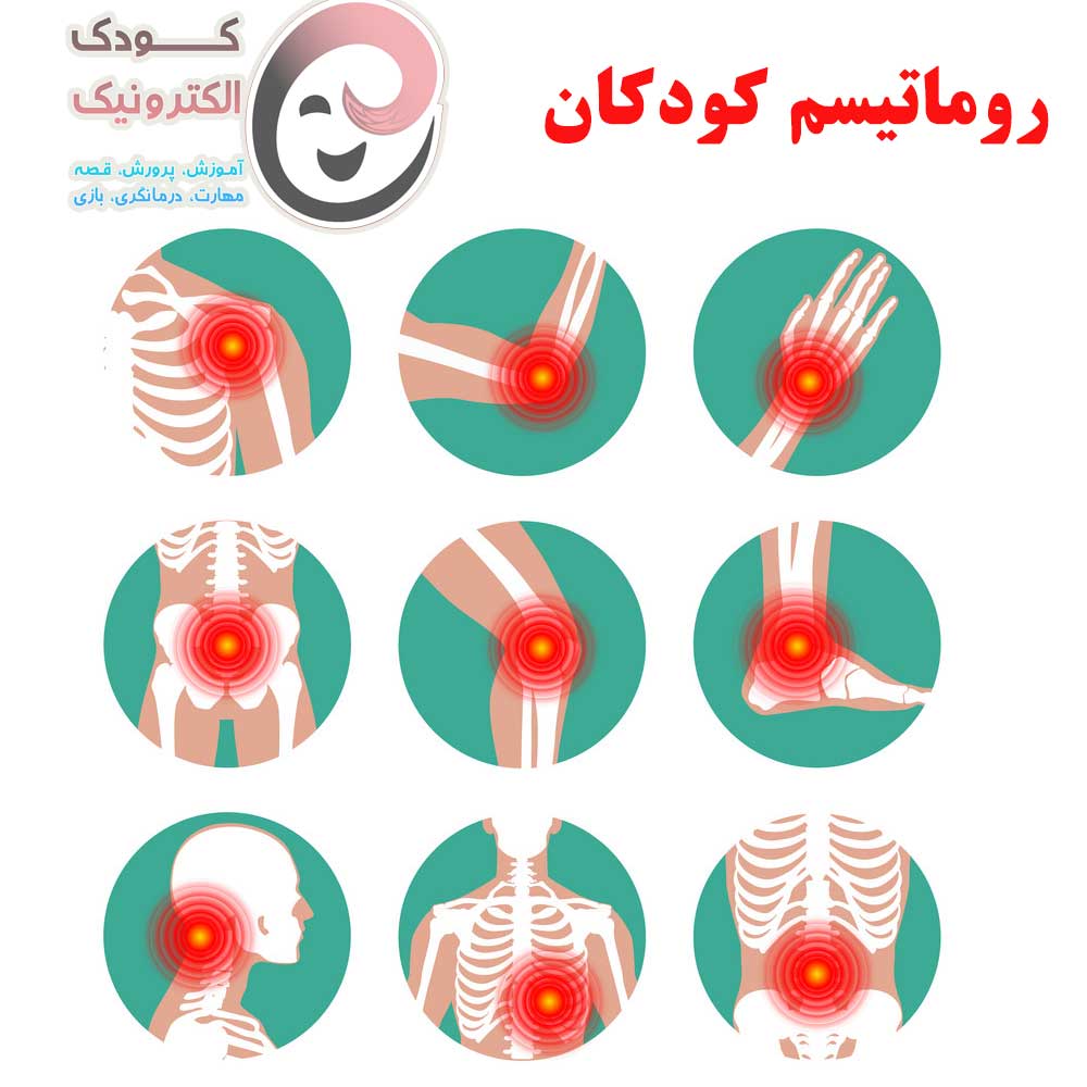 روماتیسم کودکان،علائم و درمانهای خانگی