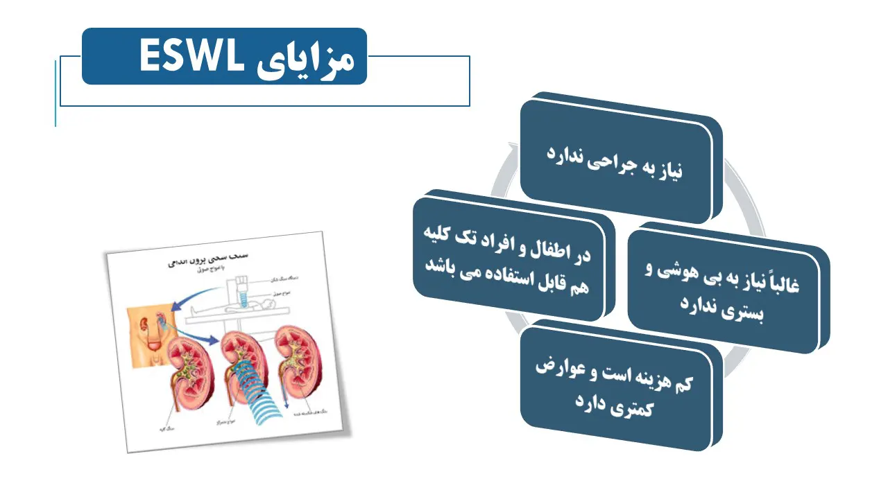 مزایای روش ESWL